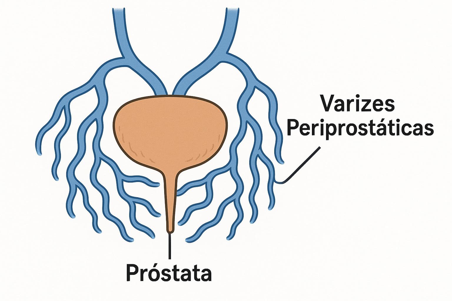 Anatomia vascular masculina mostrando varizes periprostáticas. Síndrome de Congestão pélvica